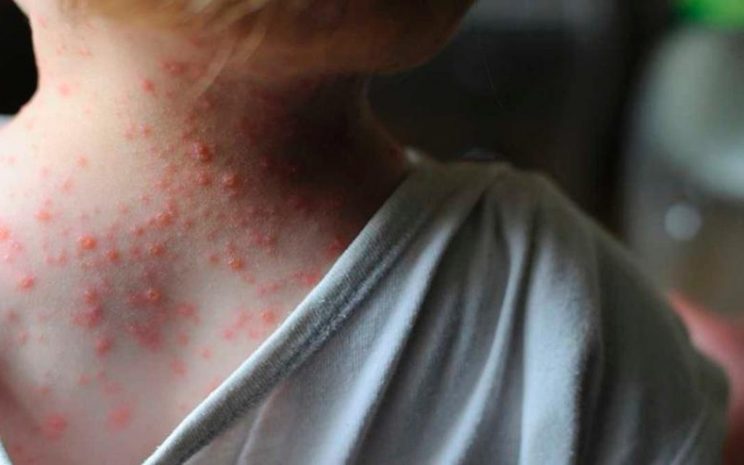 Fiebre-del-Mono-744x465