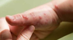 Cuba-esta-preparada-viruela-para-enfrentar-viruela-simica-22-08-2022